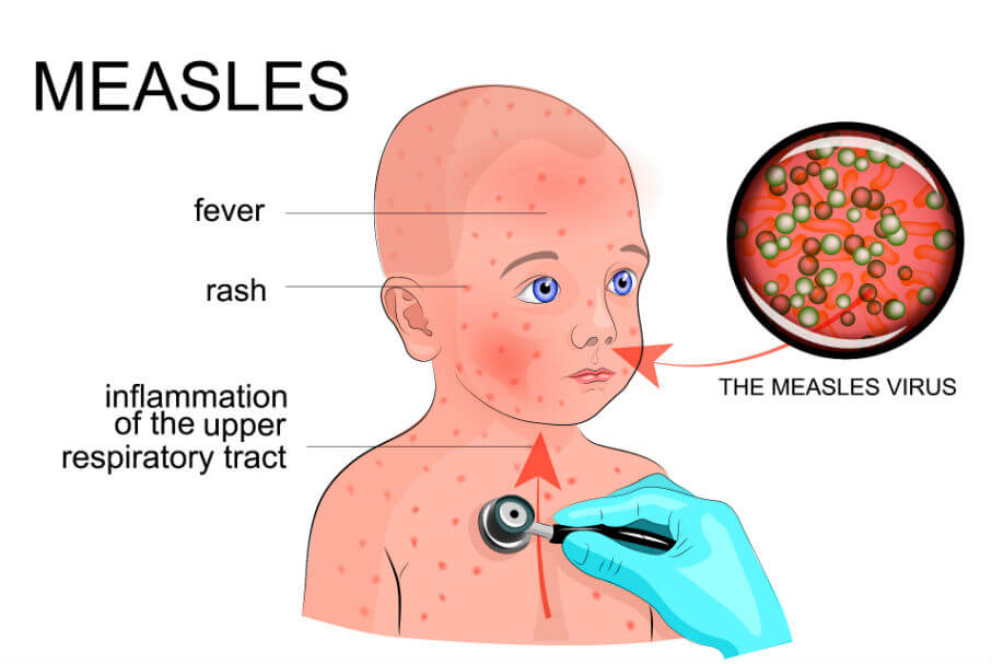 Measles Outbreaks Reported in Israel, New Zealand, Moldova, and